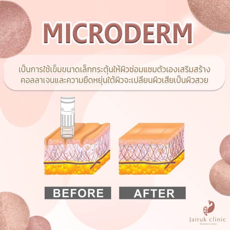 Microderm จะกระตุ้นเปลี่ยนผิวเสียเป็นผิวสวย