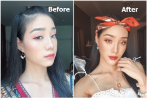 Read more about the article สวยแล้ว ก็สวยอีกได้ แค่มีคางหน้าก็เรียวขึ้นด้วย Filler ถ่ายรูปมุมไหนก็ปังทุกองศา