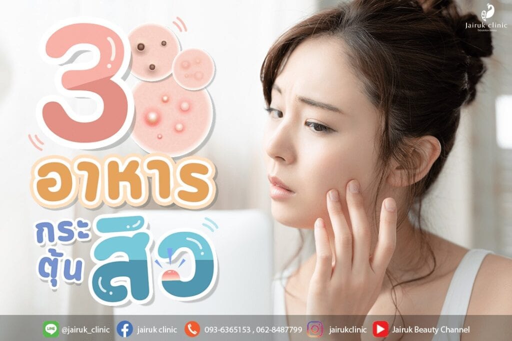 3 อาหาร กระตุ้นการเกิดสิว เป็นสิว ห้ามกินอะไร อาหารที่กินแล้วเป็นสิว